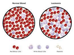 Another Amazing Achievement of Congress 60: Leukemia Is Eventually Treated